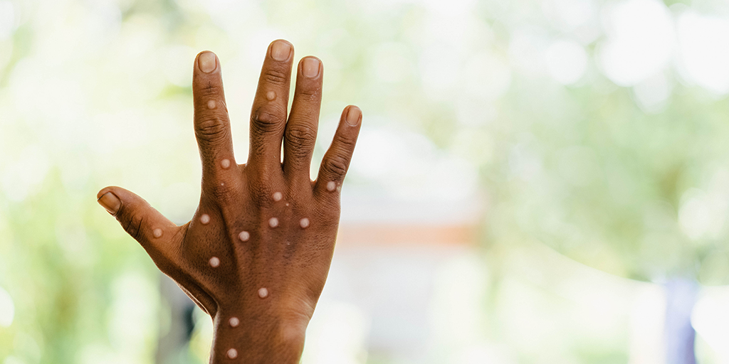 a hand with lumps on it and text in front